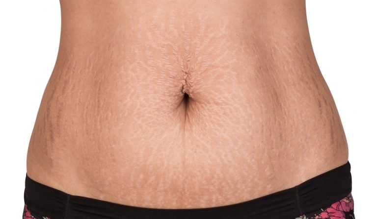 How to Get Rid of Stretch Marks Fast
