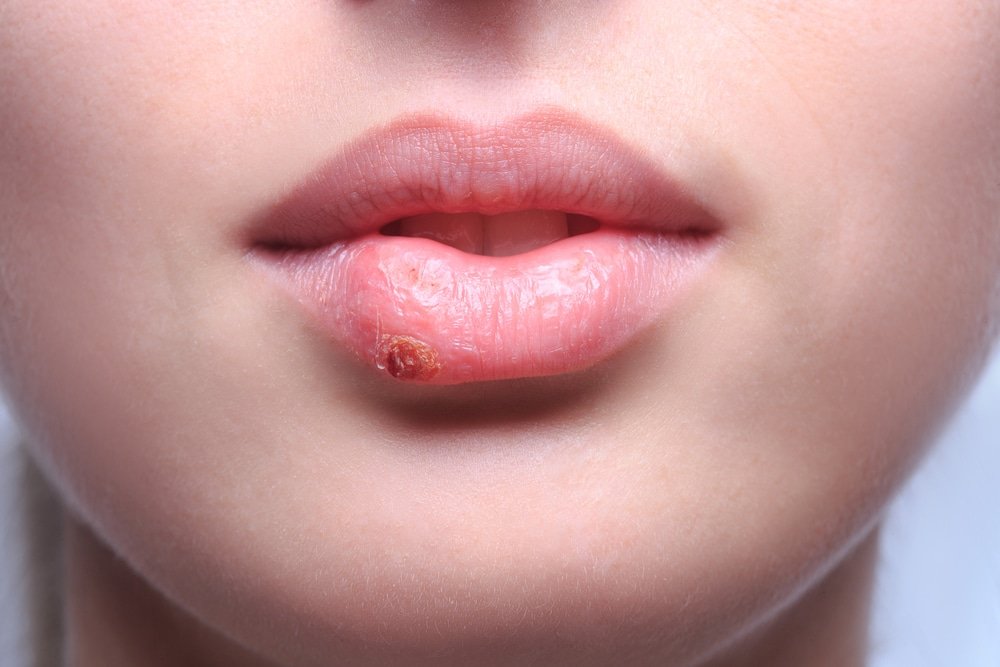 10 Home Remedies for Herpes