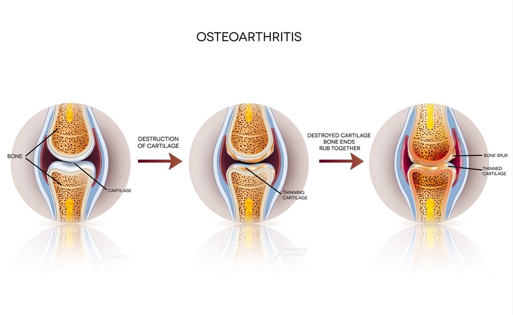 11 Home Remedies for Osteoarthritis