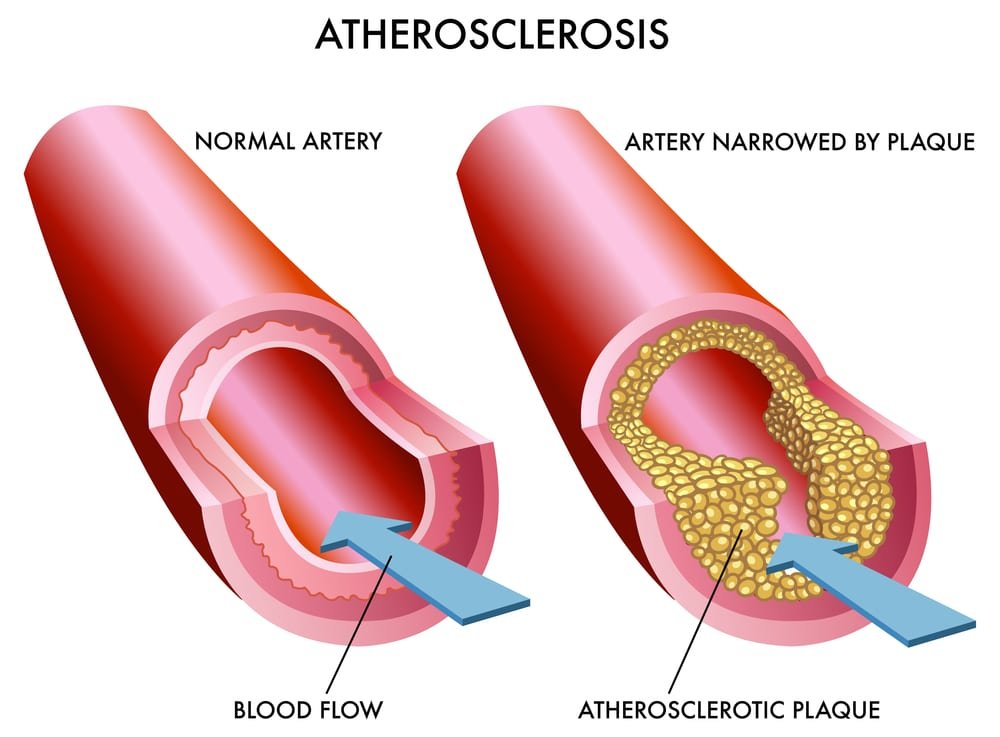 9 Home Remedies for Atherosclerosis