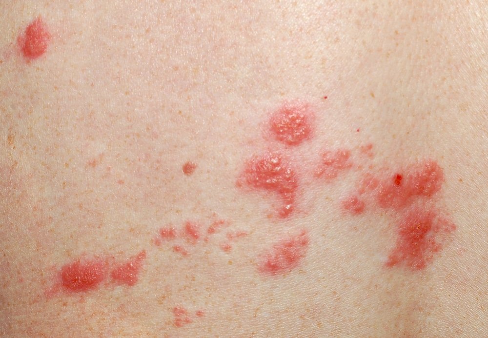 11 Natural Treatment for Ringworm