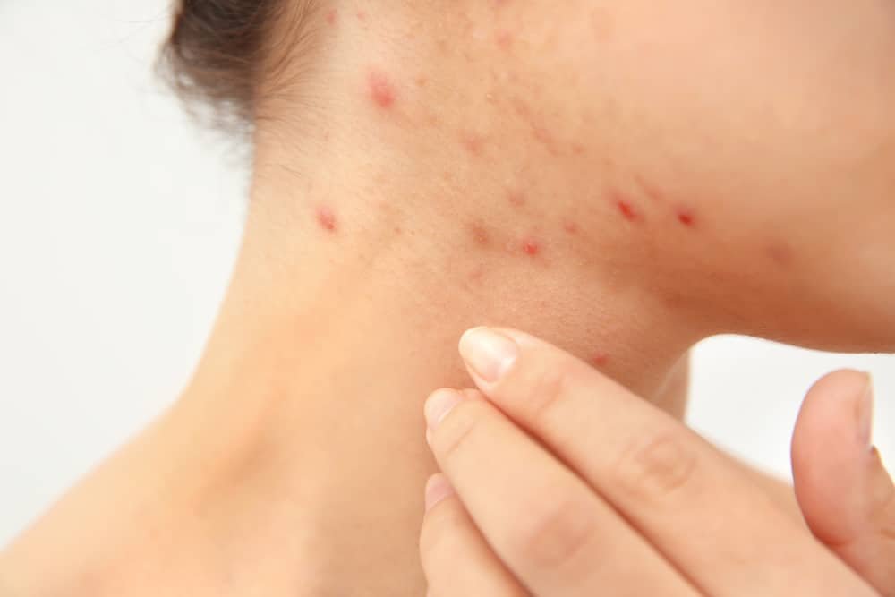 9 Natural Treatments for Scabies