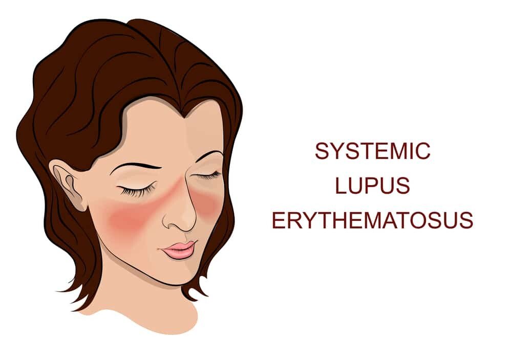 Symptoms Of Lupus