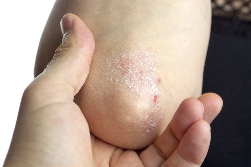  Types of Psoriasis