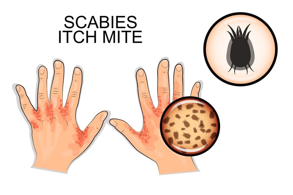 Scabies Symptoms Causes And Treatment Natural Food Series