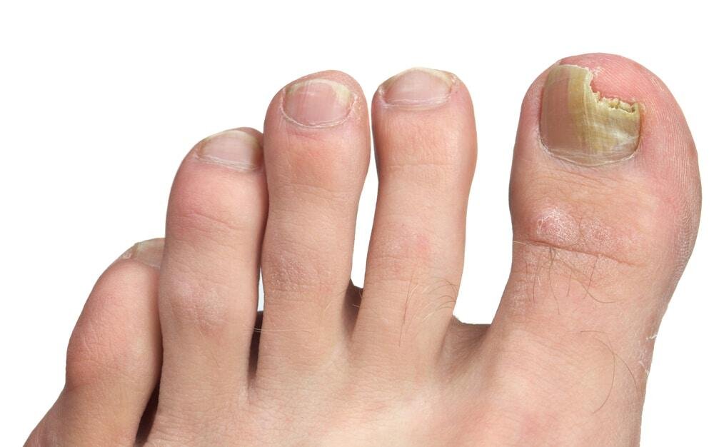 11 Home Remedies for Toenail Fungus