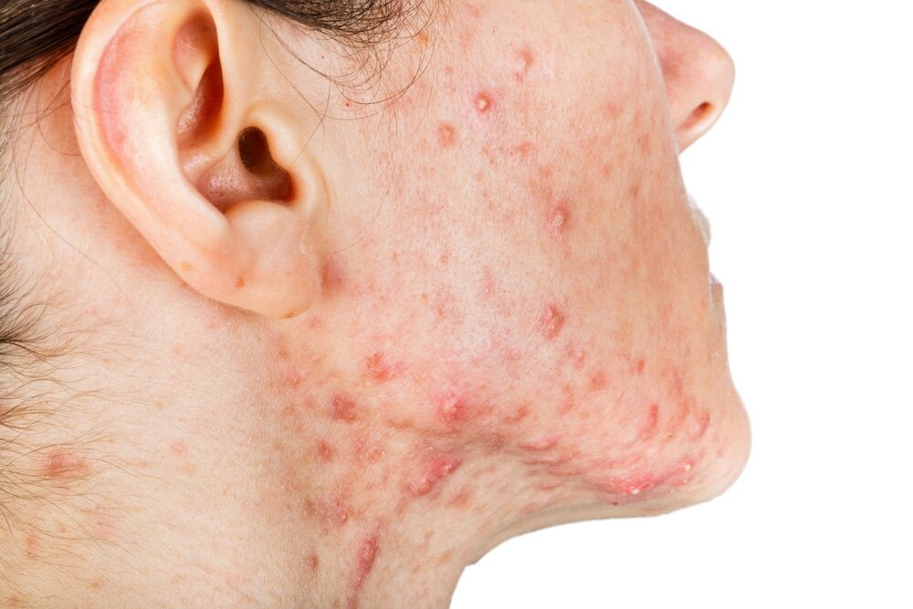 Skin Infection: Types, Causes and Treatments