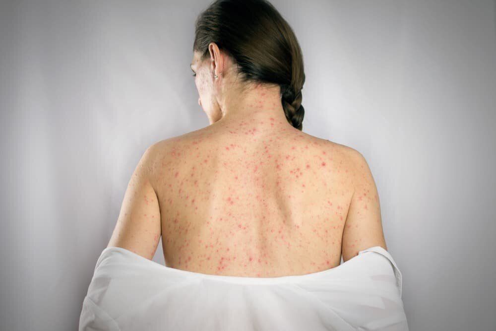 Shingles Symptoms Causes And Treatment Natural Food