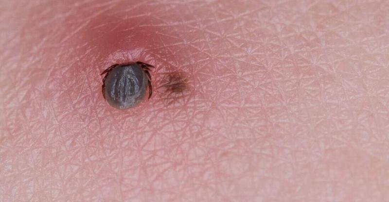 Tick Bites On Humans Symptoms